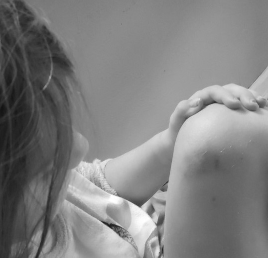 A picture of a child with a bruised knee. Mindfulness can help to reduce pain.